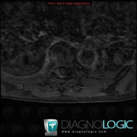 Lymphoma, Spinal canal / Cord, MRI