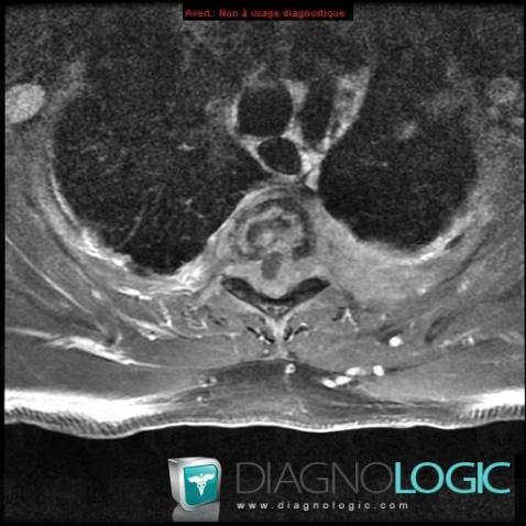 Lymphoma, Spinal canal / Cord, MRI