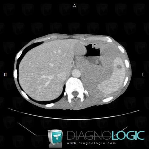 Lymphoma, Spleen, CT