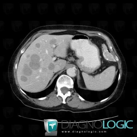 Lymphoma, Spleen, CT