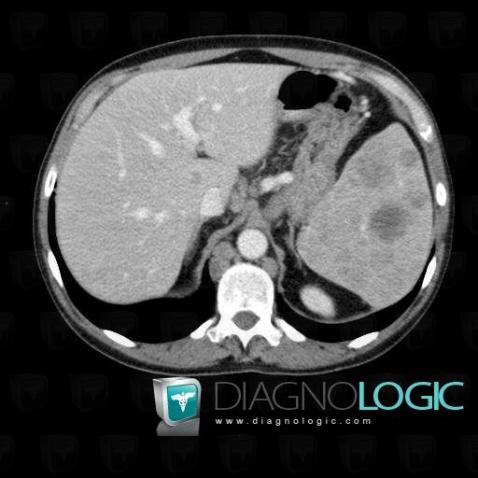 Lymphoma, Spleen, CT