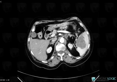Lymphoma, Spleen, CT