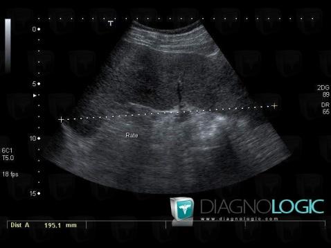 Lymphoma, Spleen, US