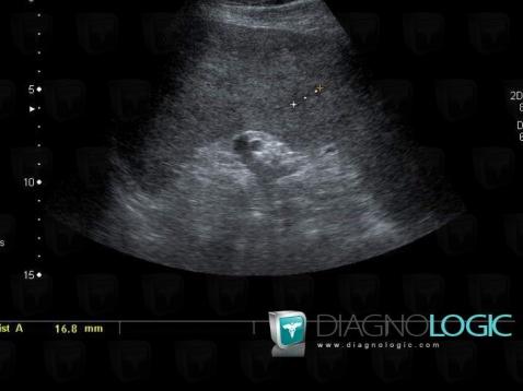 Lymphoma, Spleen, US