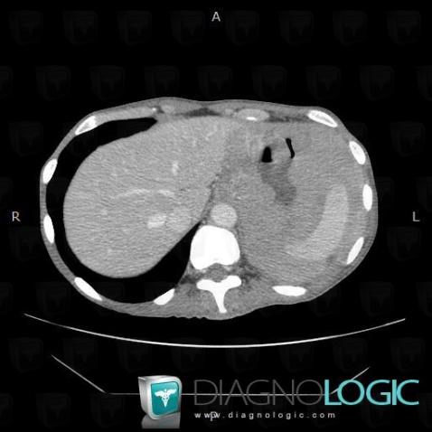 Lymphoma, Stomach, CT