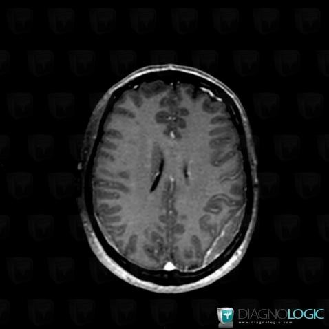 Lymphoma, Supratentorial peri cerebral spaces, MRI