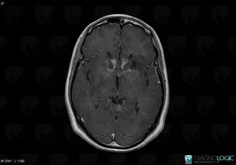 Lymphoma, Supratentorial peri cerebral spaces, MRI