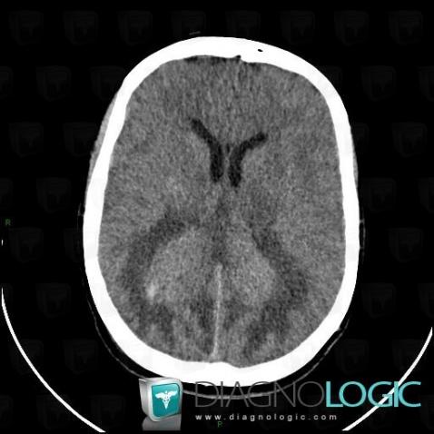 Lymphoma, Ventricles / Periventricular region, CT