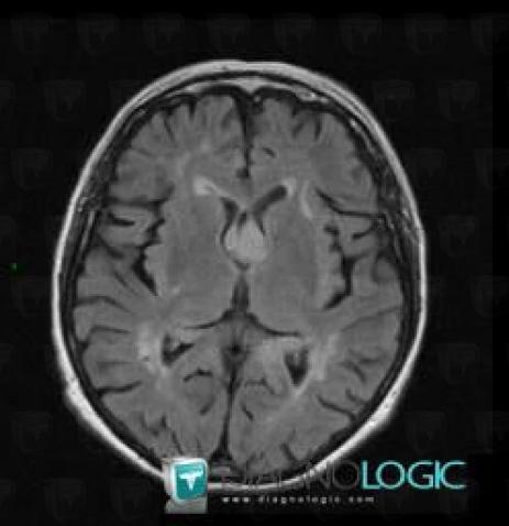 Lymphoma, Ventricles / Periventricular region, MRI