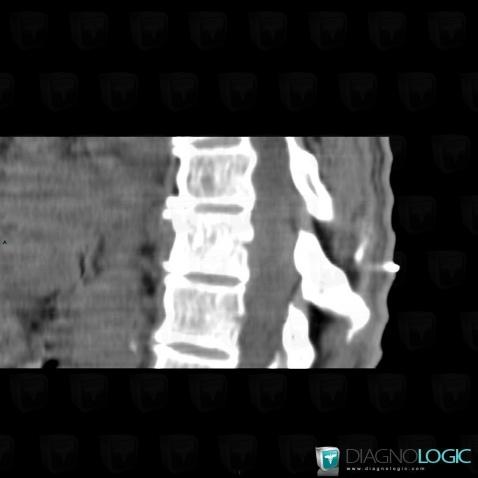 Lymphoma, Vertebral body / Disk, CT