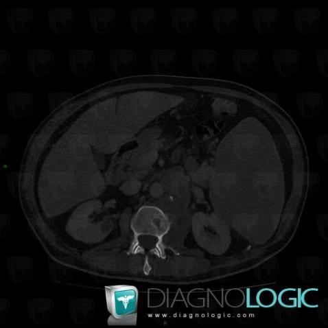 Lymphoma, Vertebral body / Disk, CT