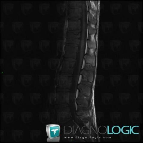 Lymphoma, Vertebral body / Disk, MRI