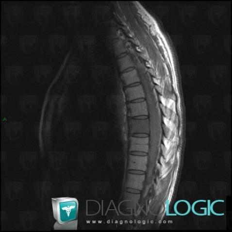 Lymphoma, Vertebral body / Disk, MRI