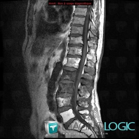 Lymphoma, Vertebral body / Disk, MRI