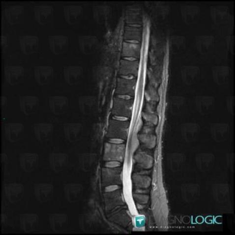 Lymphoma, Vertebral body / Disk, Spinal canal / Cord, MRI