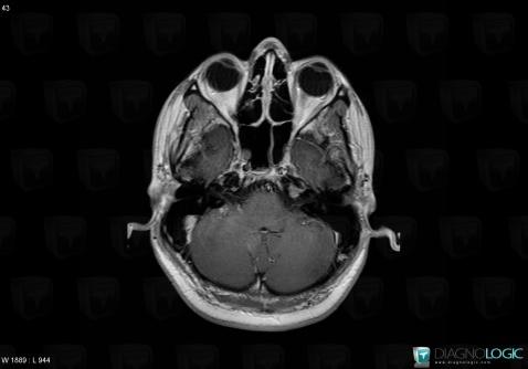 Lymphoma, VII VIII nerves, MRI