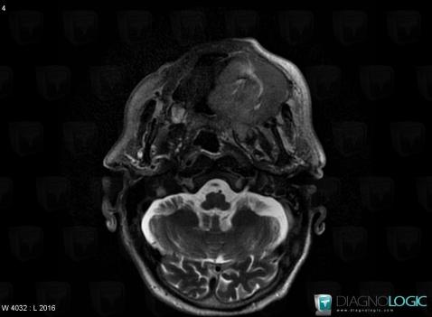 Lymphome , Espaces profonds de-face, IRM