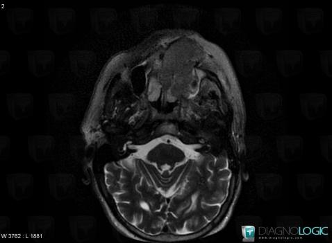 Lymphome , Fosses nasales / Nasopharynx, IRM