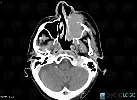 Lymphome , Fosses nasales / Nasopharynx, Scanner