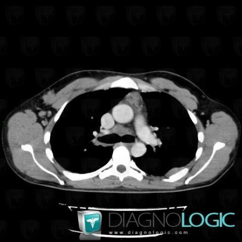 Lymphome , Médiastin, Scanner