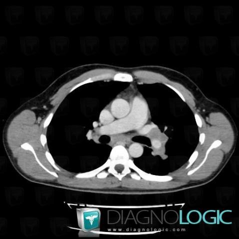 Lymphome , Médiastin, Scanner