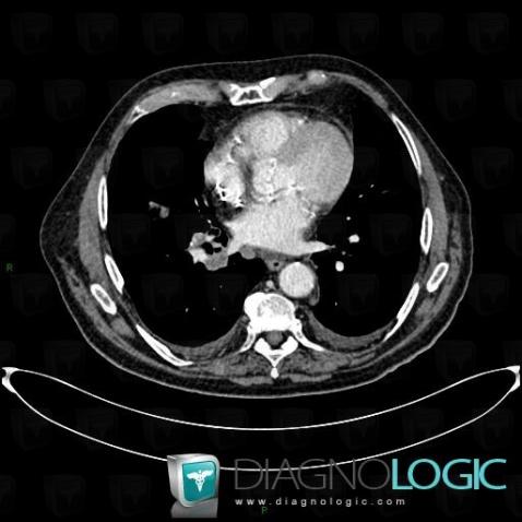 Lymphome , Médiastin, Scanner