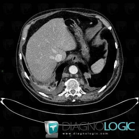 Lymphome , Médiastin, Scanner