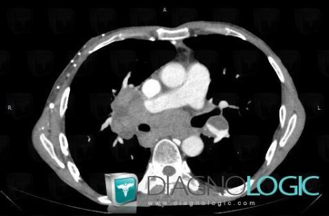 Lymphome , Médiastin, Scanner