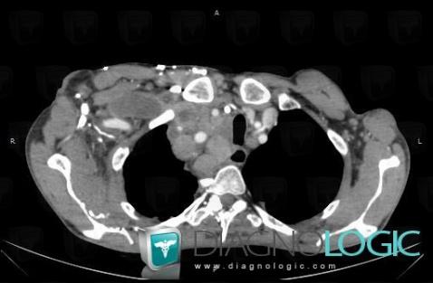 Lymphome , Médiastin, Scanner