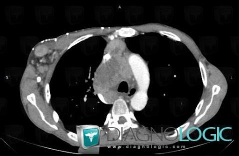 Lymphome , Médiastin, Scanner