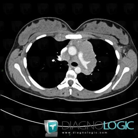 Lymphome , Médiastin, Scanner