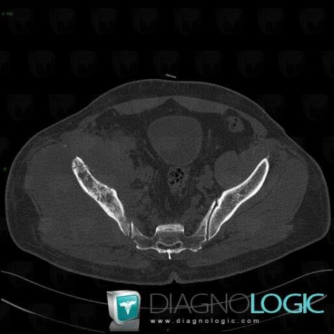 Lymphome , Muscles - Bassin, Scanner