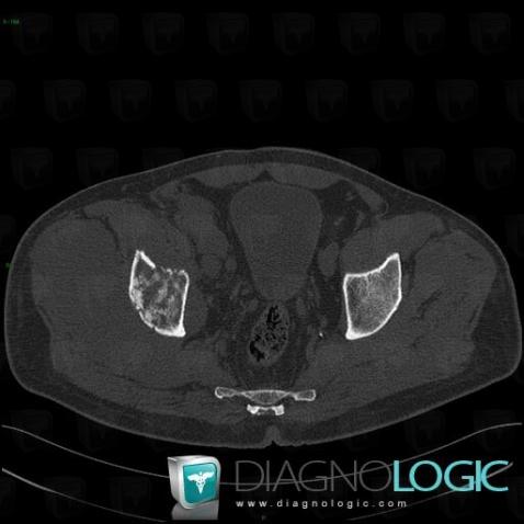 Lymphome , Os iliaque, Scanner