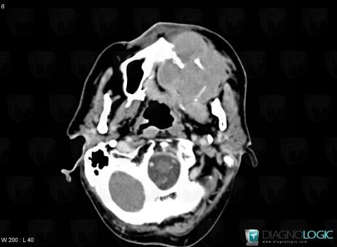 Lymphome , Palais, Espaces profonds de-face, Scanner