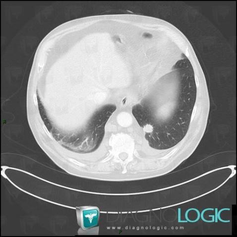 Lymphome , Parenchyme pulmonaire, Scanner