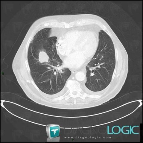 Lymphome , Parenchyme pulmonaire, Scanner