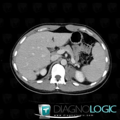 Lymphome , Rétroperitoine, Scanner