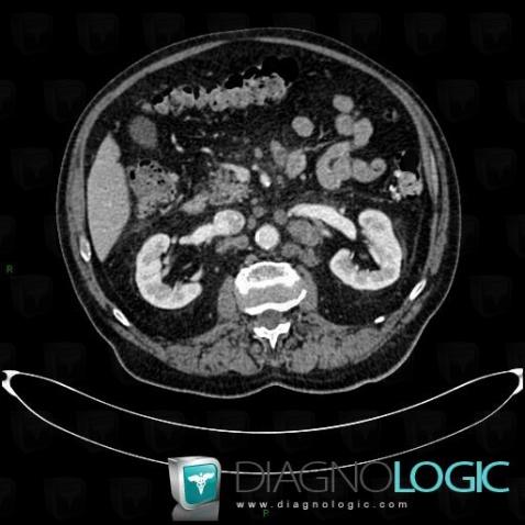 Lymphome , Rétroperitoine, Scanner