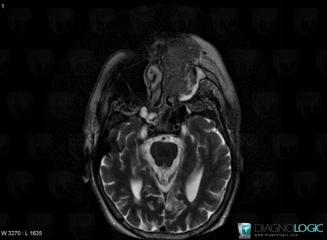 Lymphome , Sinus, IRM