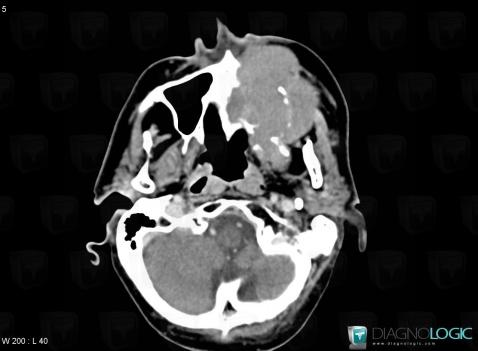 Lymphome , Sinus, Maxillaire, Scanner