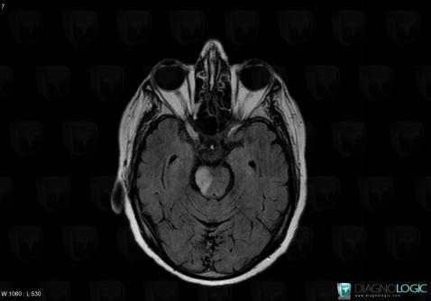 Lymphome , Tronc cérébral, IRM
