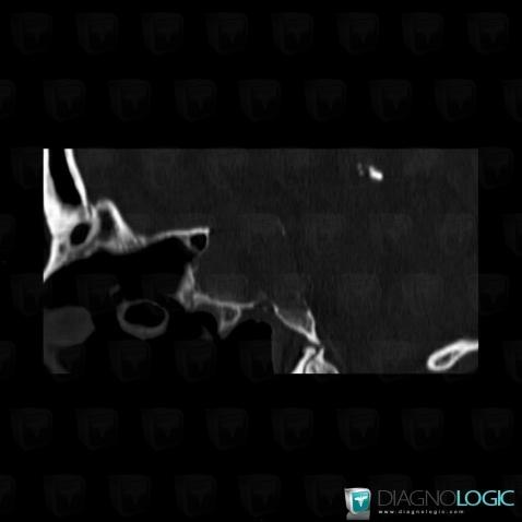 Macroadénome hypophysaire, Sphenoïde, Scanner