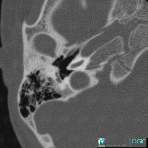 Major aplasia, External ear, CT