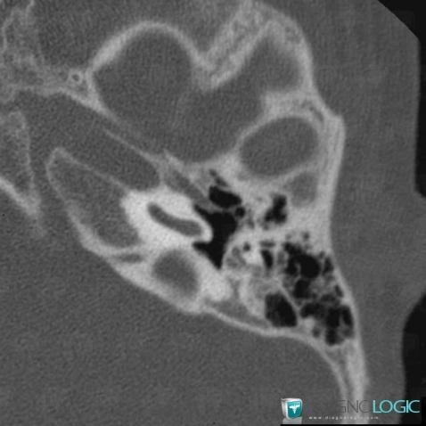 Major aplasia, External ear, CT