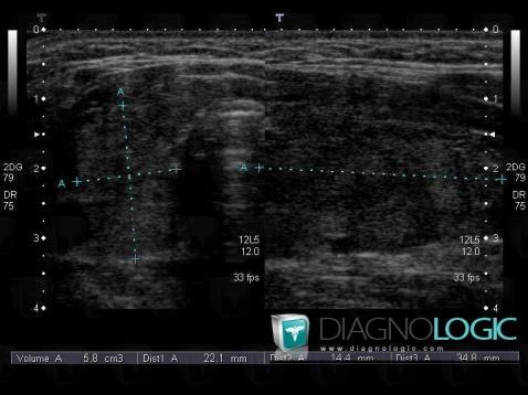 Maladie-Basedow, Thyroïde/ Parathyroïde, Echographie