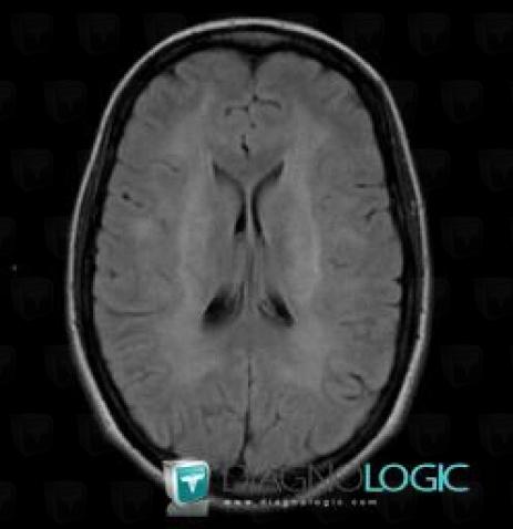 Maladie-Canavan, Hémisphères cérébraux, IRM