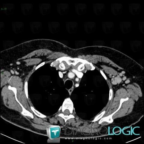 Maladie-Castleman , Paroi thoracique, Scanner
