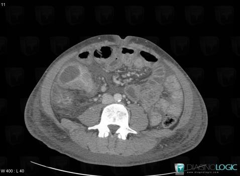 Maladie-Crohn, Caecum / Appendice, Scanner