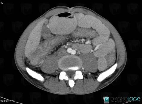 Maladie-Crohn, Colon, Scanner