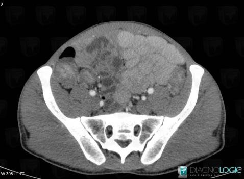 Maladie-Crohn, Intestin grêle, Caecum / Appendice, Scanner